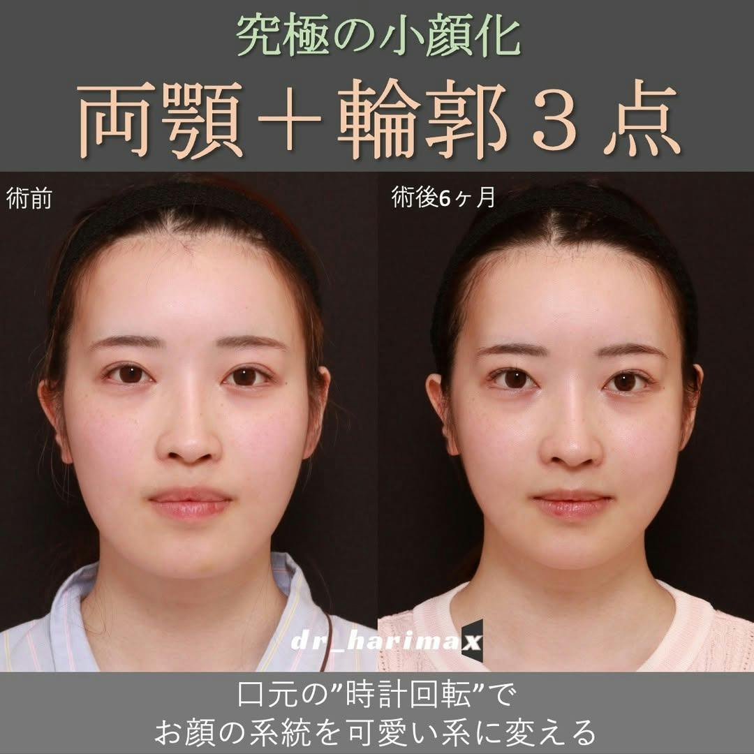 【女性・顔】上下顎骨切り術・輪郭3点_before_aftar