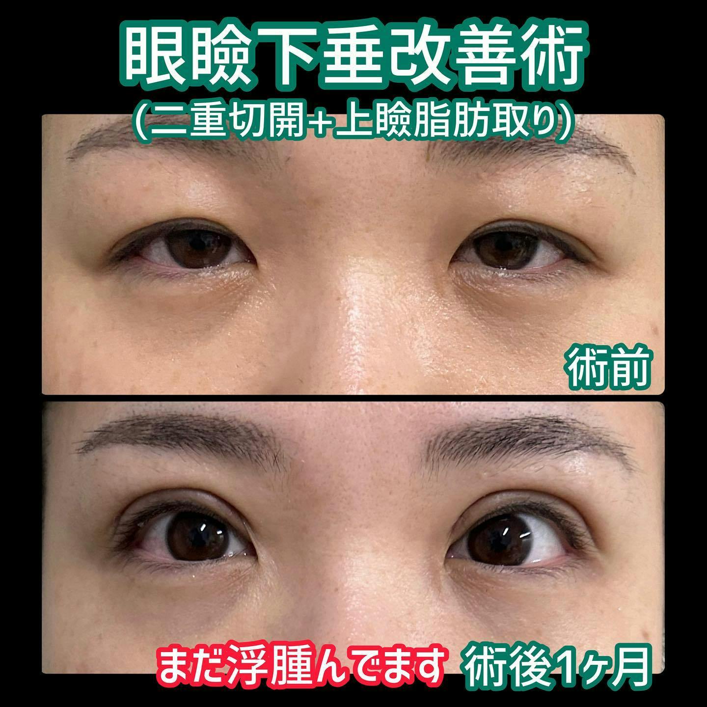 【女性・目元】眼瞼下垂改善術（二重切開＋上瞼脂肪取り）_before_aftar