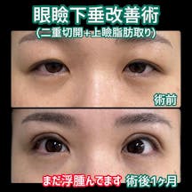 【女性・目元】眼瞼下垂改善術(二重切開+上瞼脂肪取り)_before_aftar