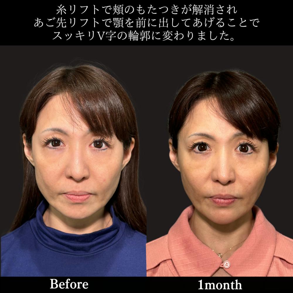 【40代女性・顔】PRISMリフト＋あご先リフト＋エラのボトックス注射_before_aftar