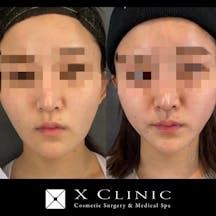 【女性・輪郭】糸リフト_before_aftar