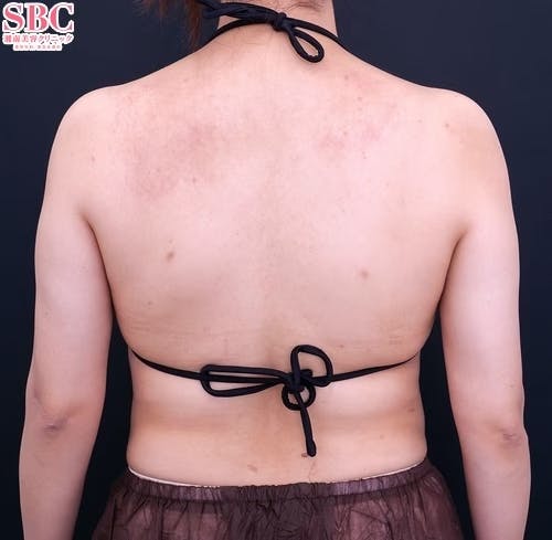 【20代女性・二の腕】Aquicell（アキーセル）脂肪吸引・根こそぎVASER脂肪吸引_after