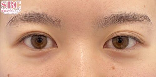 【女性・目元】クイックコスメティーク・ダブルNeo_before