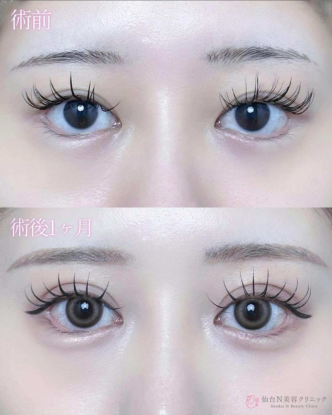 【女性・目元】二重埋没法（シークレットトリプル）_before_aftar