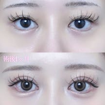 【女性・目元】二重埋没法(シークレットトリプル)_before_aftar