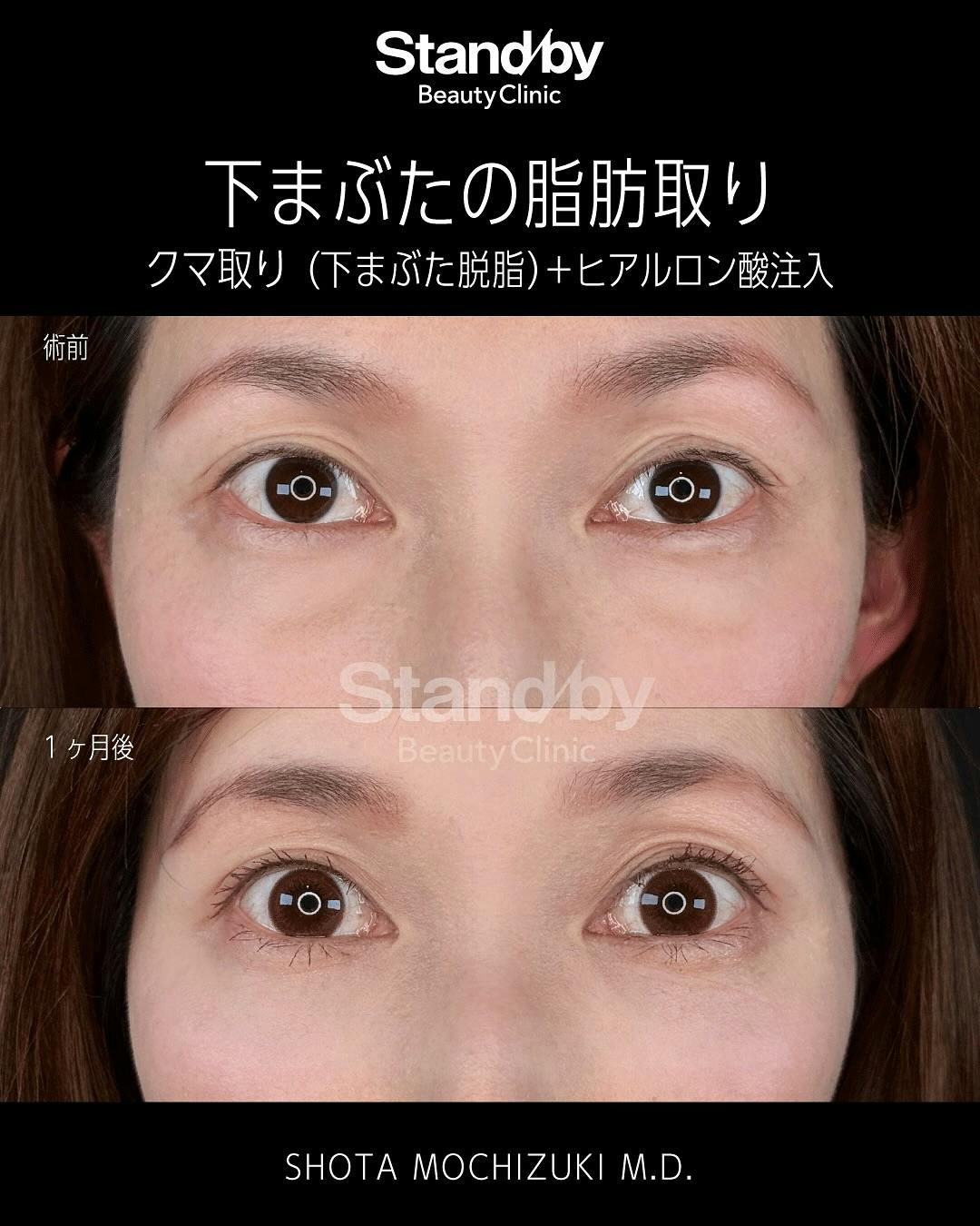 【女性・クマ】クマ取り(下まぶた脱脂) ヒアルロン酸注入_before_aftar
