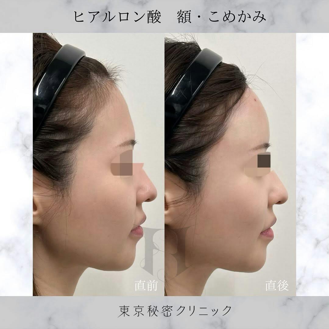 【女性・ハリ】ヒアルロン酸（額・こめかみ）_before_aftar