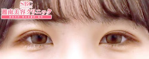 【女性・目元】クイックコスメティーク・ダブルNeo・自然癒着セット（上眼瞼脱脂）_aftar