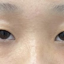 【女性・目元】週末二重術2点(埋没法/切らない二重手術)_before