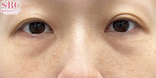 【女性・目元】目の下の切らないクマ・たるみ（ふくらみ）取り_before