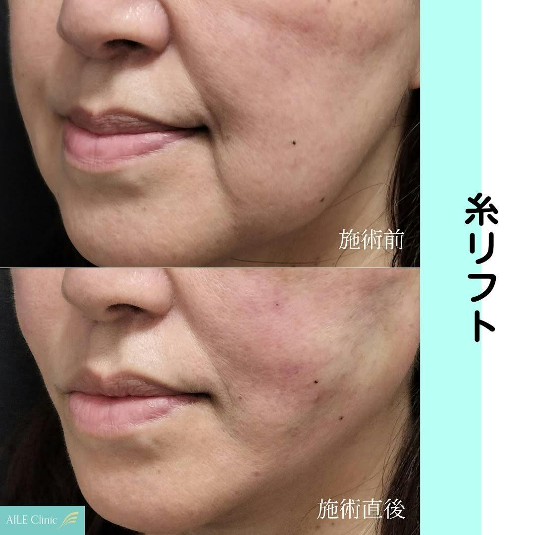 【女性・小顔】糸リフト_before_aftar
