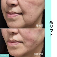 【女性・小顔】糸リフト_before_aftar