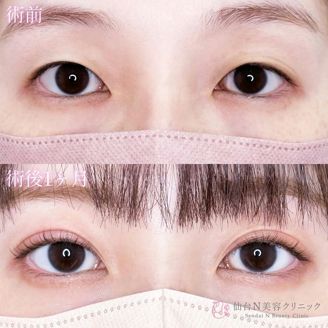 【女性・目元】二重埋没法（シークレットトリプル）_before_aftar