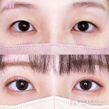 【女性・目元】二重埋没法(シークレットトリプル)_before_aftar