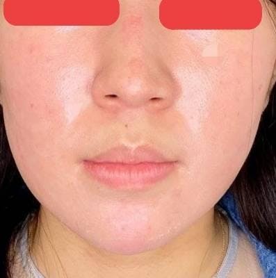 共立美容外科 新宿本院で鼻の美容整形：鼻尖形成術を受けたsakakibaraさんの写真