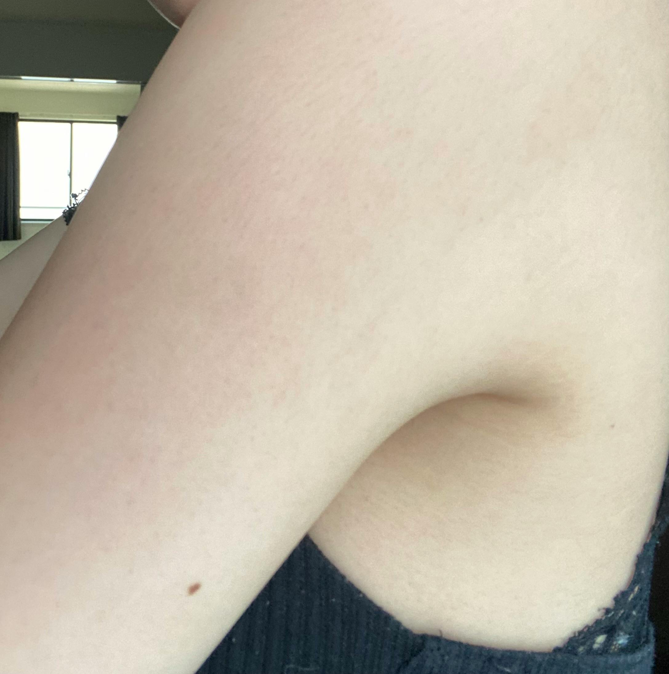 湘南美容クリニック 名古屋院で医療脱毛・胸の医療脱毛・お尻の医療脱毛・腹の医療脱毛・背中の医療脱毛・膝下の医療脱毛・肘下の医療脱毛・太もも・膝上の医療脱毛・肘上の医療脱毛を受けたあいさんの写真