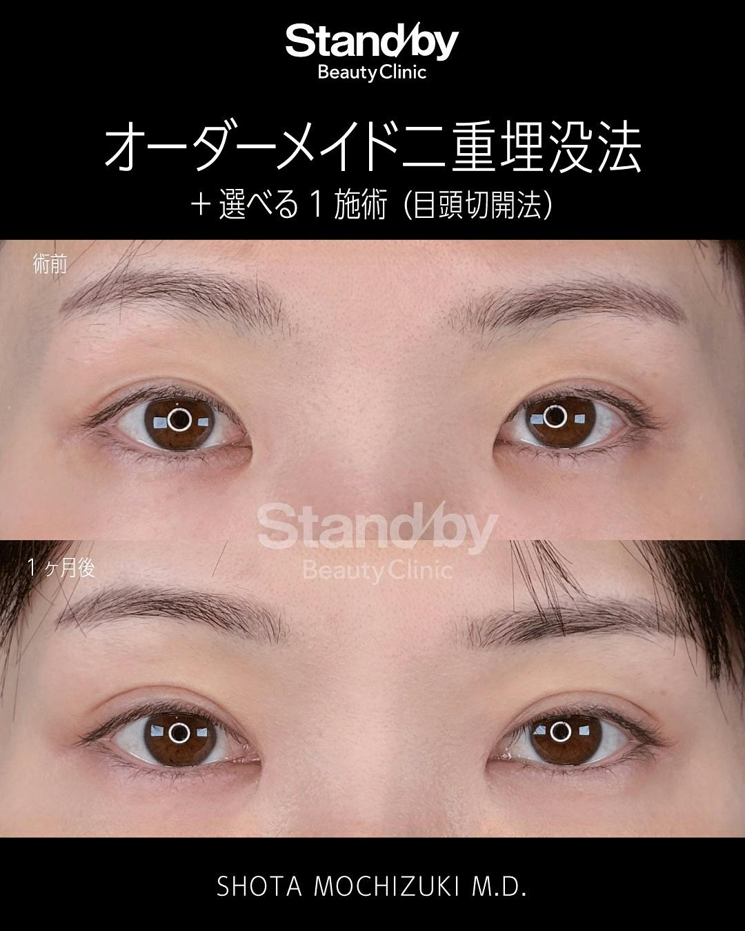 【女性・目元】オーダーメイド二重埋没法 目頭切開_before_aftar