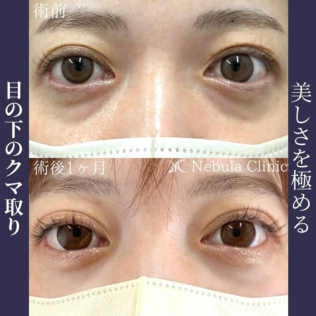 【女性・クマ】切らない目の下のクマ取り・たるみ取り_before_aftar