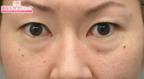 【40代女性・目元】目の下の切らないクマ・たるみ（ふくらみ）取り ナチュラル脂肪注射コンデンスリッチ ナチュラル脂肪注射ナノリッチ_before