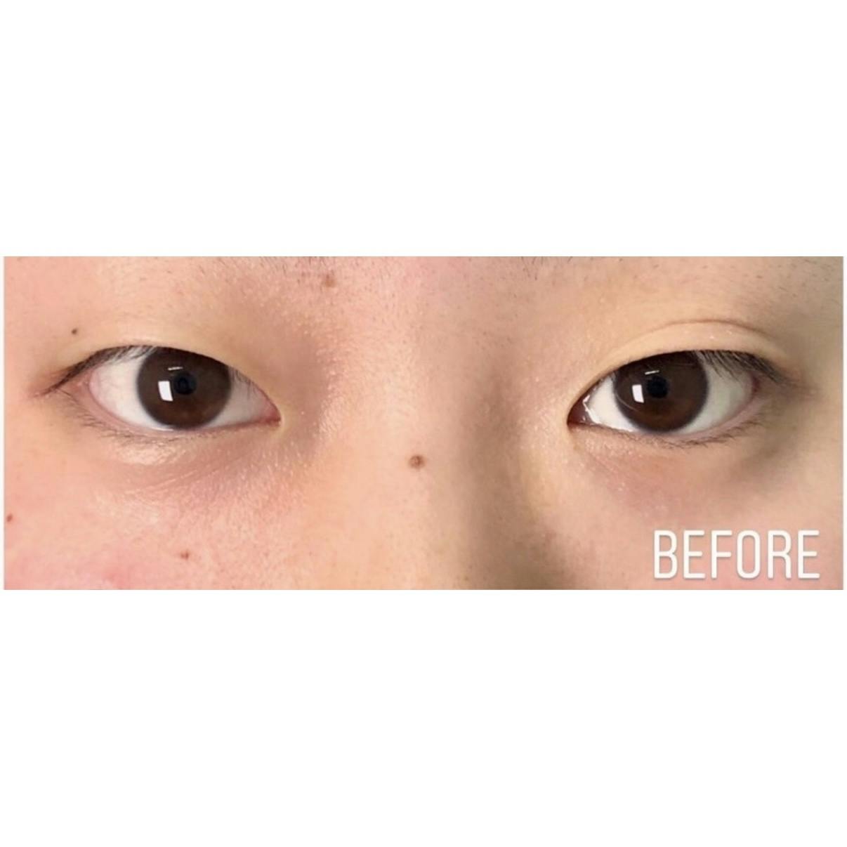 湘南美容クリニック 大阪梅田本院で二重整形・二重自然癒着法(切らない二重手術)・二重埋没・奥二重整形・末広二重整形・平行二重整形・ミックス型二重整形・目元整形を受けたnaagiiさんの写真