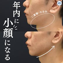 【男性・小顔】顔のたるみ取り(HIFU UltracelQ+)_before_aftar