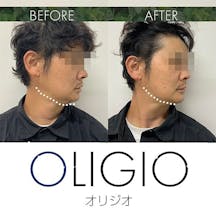 【男性・たるみ】リフトアップ(オリジオ)_before_aftar