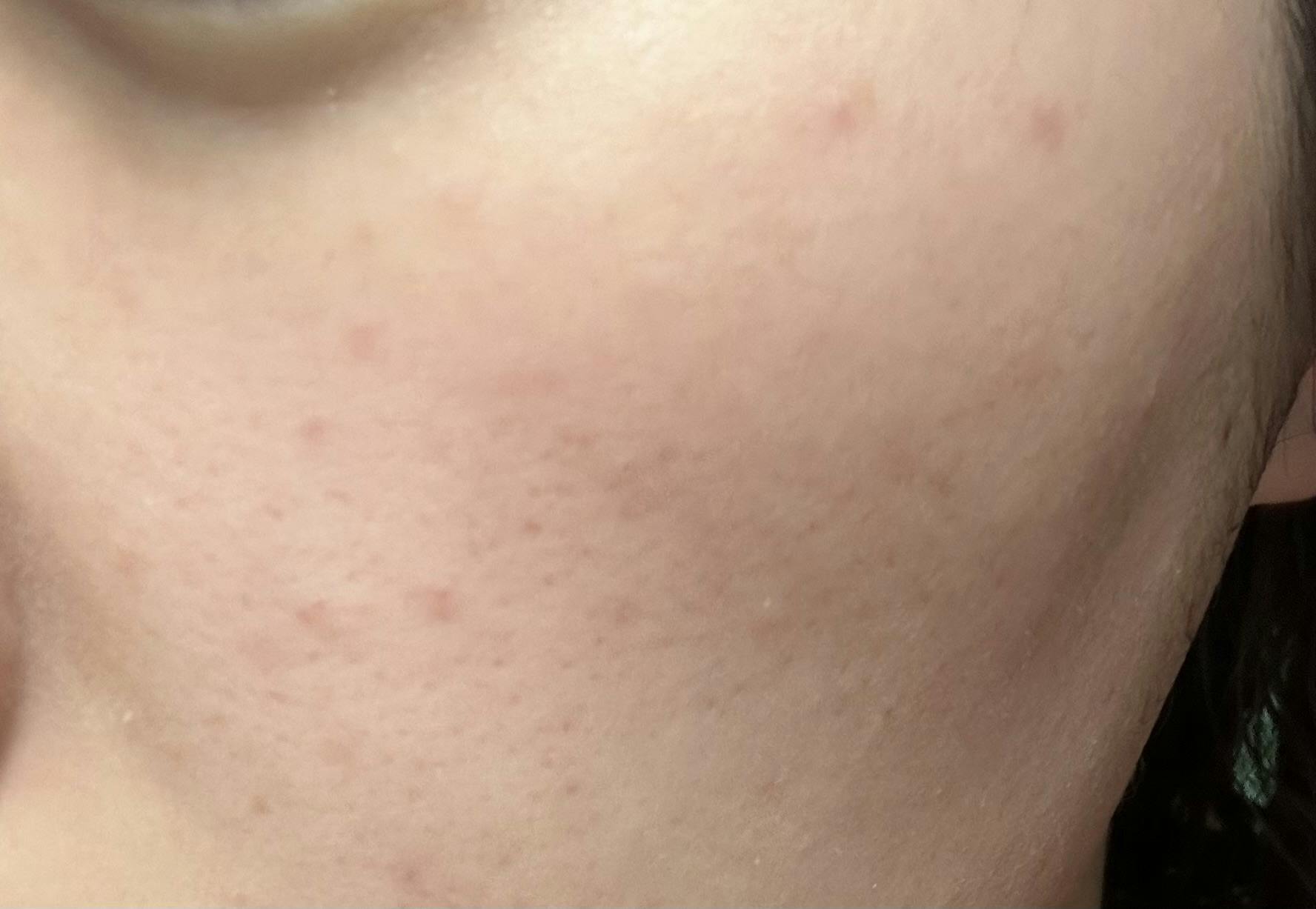 ソワカウィメンズヘルスクリニック(sowaka women’s health clinic)でヴェルベットスキンを受けたTiさんの写真