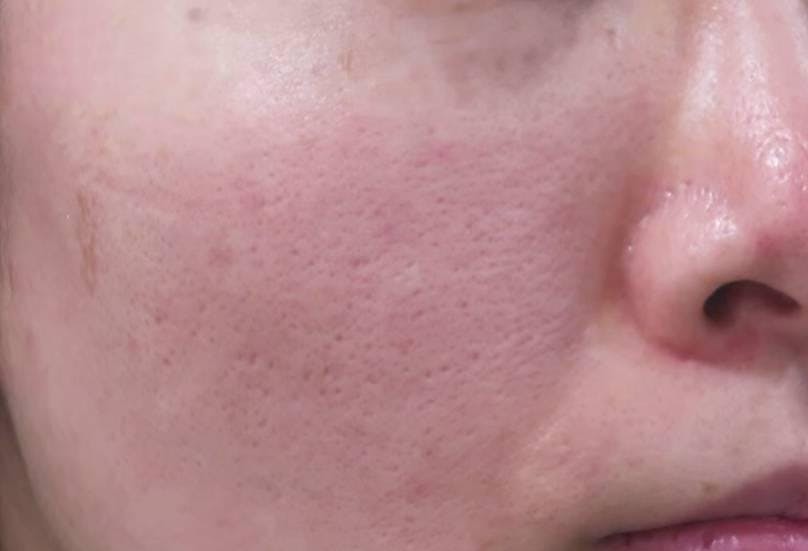 品川スキンクリニック 品川本院でコラーゲンピール+顔フォトシルクプラス+水玉スキン:コラーゲンピール+顔フォトシルクプラス+水玉スキンを受けたゆりさんの写真