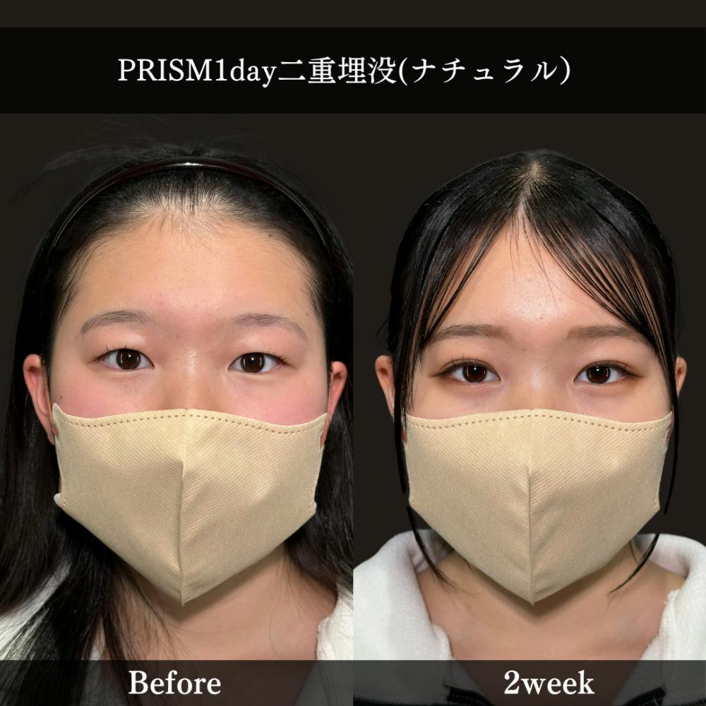 【10代女性・目】PRISM 1day二重埋没_before_aftar