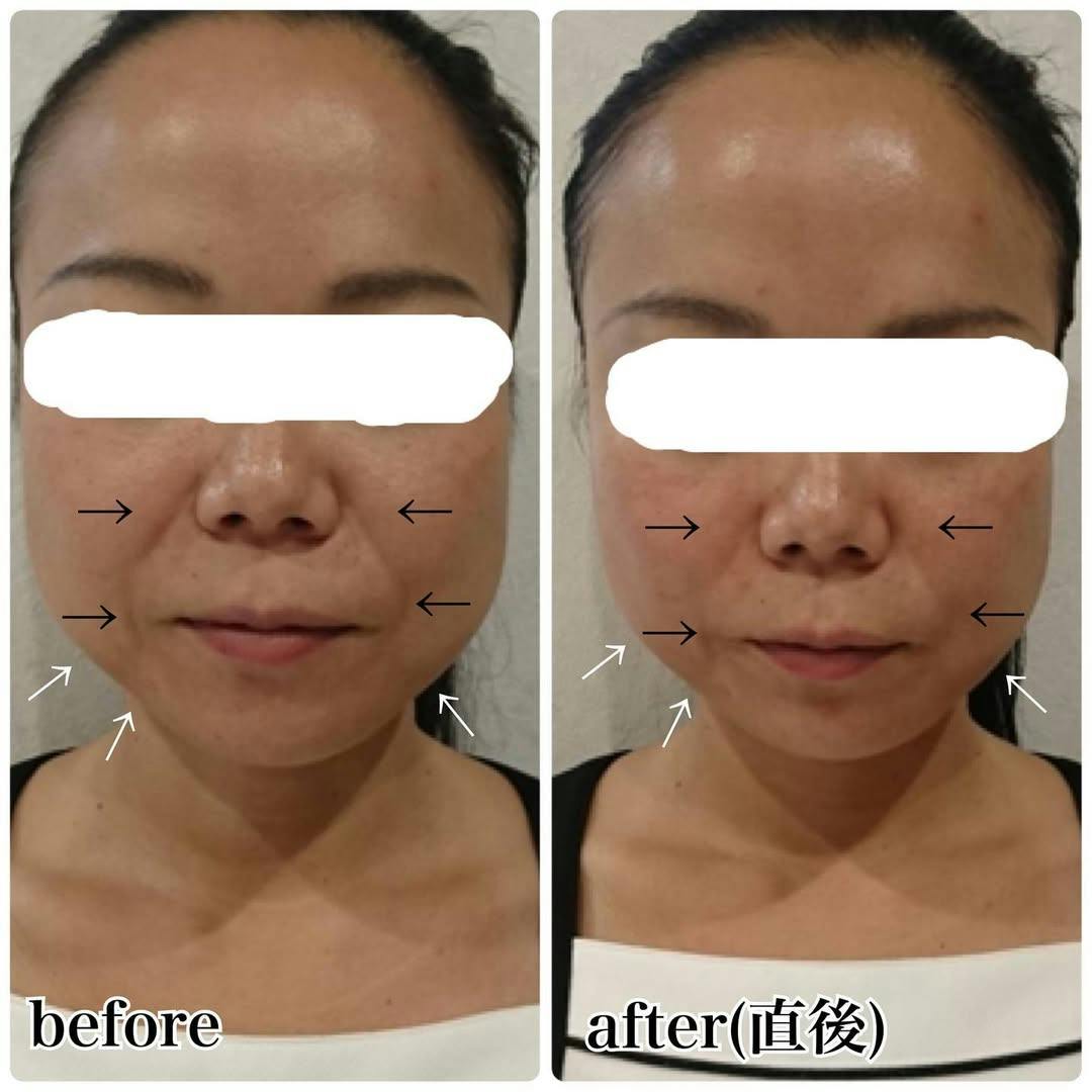 【36歳女性・小顔】スーパーハイフ_before_aftar