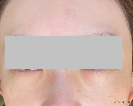 湘南美容クリニック 品川院で目の下のくまとりを受けたarai03さんの写真