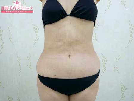 【女性・腹部】根こそぎVASER脂肪吸引、ライポマティック脂肪吸引、Aquicell（アキーセル）脂肪吸引_aftar