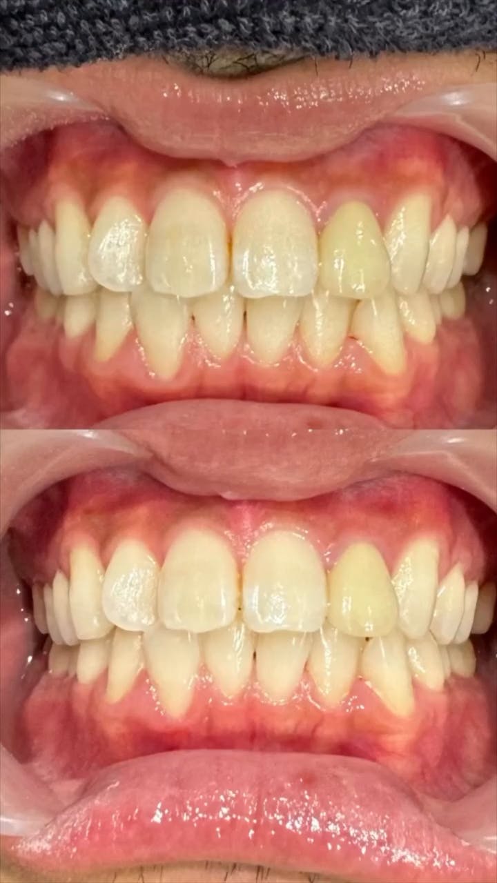 【男性・歯】ホワイトニング_before_aftar
