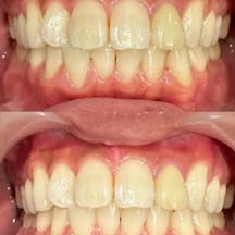 【男性・歯】ホワイトニング_before_aftar