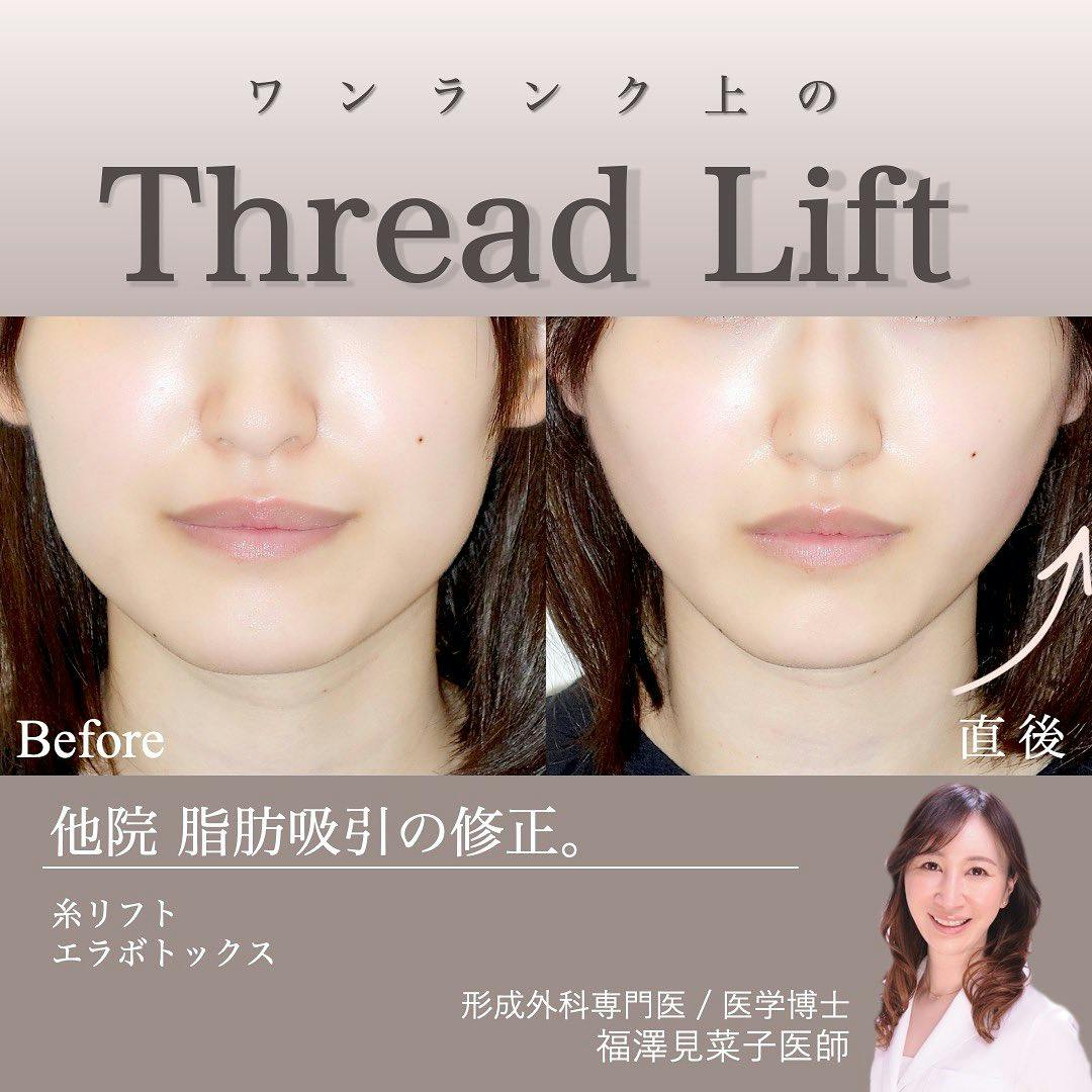 【女性・輪郭】糸リフト、エラボトックス_before_aftar