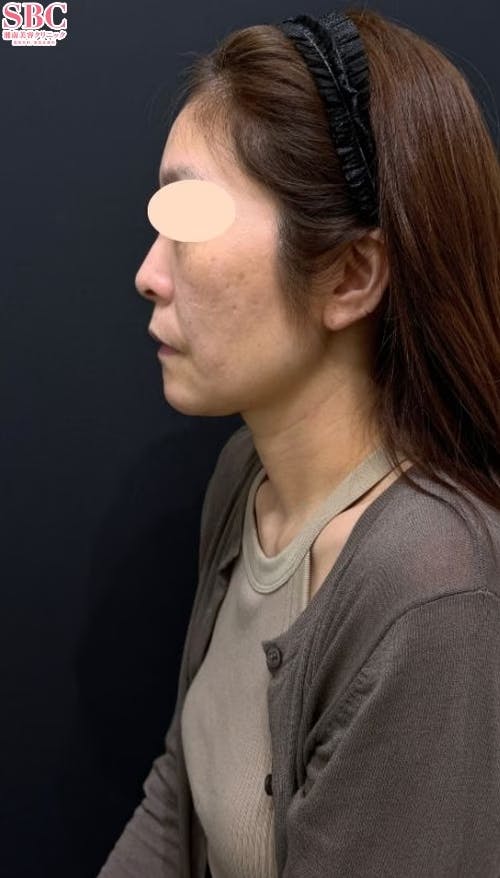 【40代女性・輪郭】ヒアルロン酸、ヒアルロン酸ジュビダームビスタ バイクロスシリーズ_before