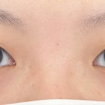 【女性・目元】線留めクロス二重術 自然癒着セット(上眼瞼脱脂) 自然癒着法_before