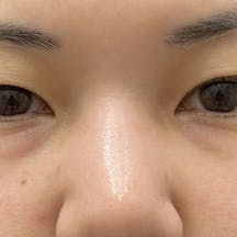 【女性・目元】裏ハムラ法・VOV(ボブ)リフト_before