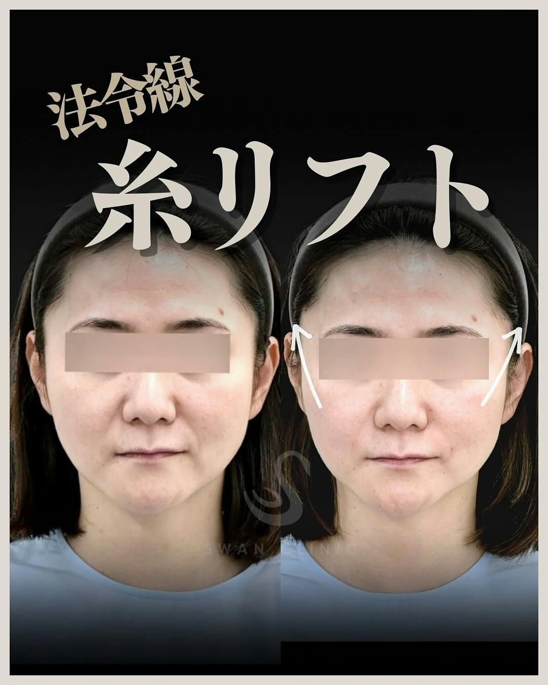 【女性・法令線】法令線の糸リフト_before_aftar