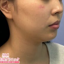 【女性・輪郭】脂肪溶解注射_before