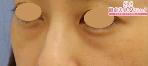 【女性・目元】目の下の切らないクマ・たるみ（ふくらみ）取り、ナチュラル脂肪注射コンデンスリッチ_before
