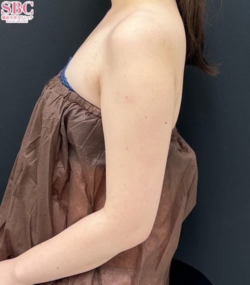 【女性・二の腕】Aquicell(アキーセル)脂肪吸引・根こそぎVASER脂肪吸引_before