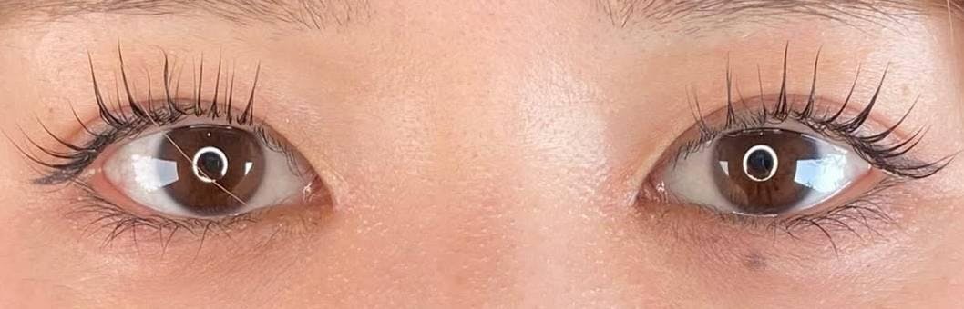 横浜TAクリニックで二重整形・目元：二重切開（全切開法）を受けたばにーさんの写真