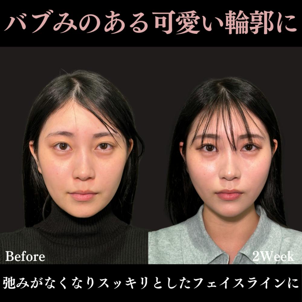 【20代女性・顔】PRISMリフト ＋ エラのボトックス注射 ＋ ヒアルロン酸注射（顎）_before_aftar