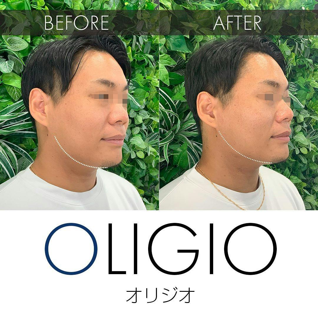 【男性・たるみ】リフトアップ(オリジオ)_before_aftar