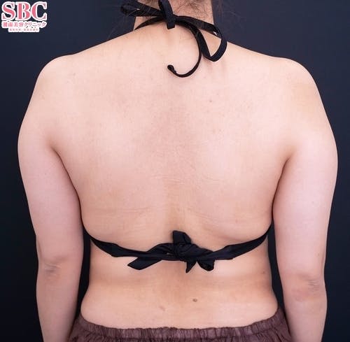 【20代女性・二の腕】Aquicell（アキーセル）脂肪吸引・根こそぎVASER脂肪吸引_before