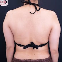 【20代女性・二の腕】Aquicell(アキーセル)脂肪吸引・根こそぎVASER脂肪吸引_before