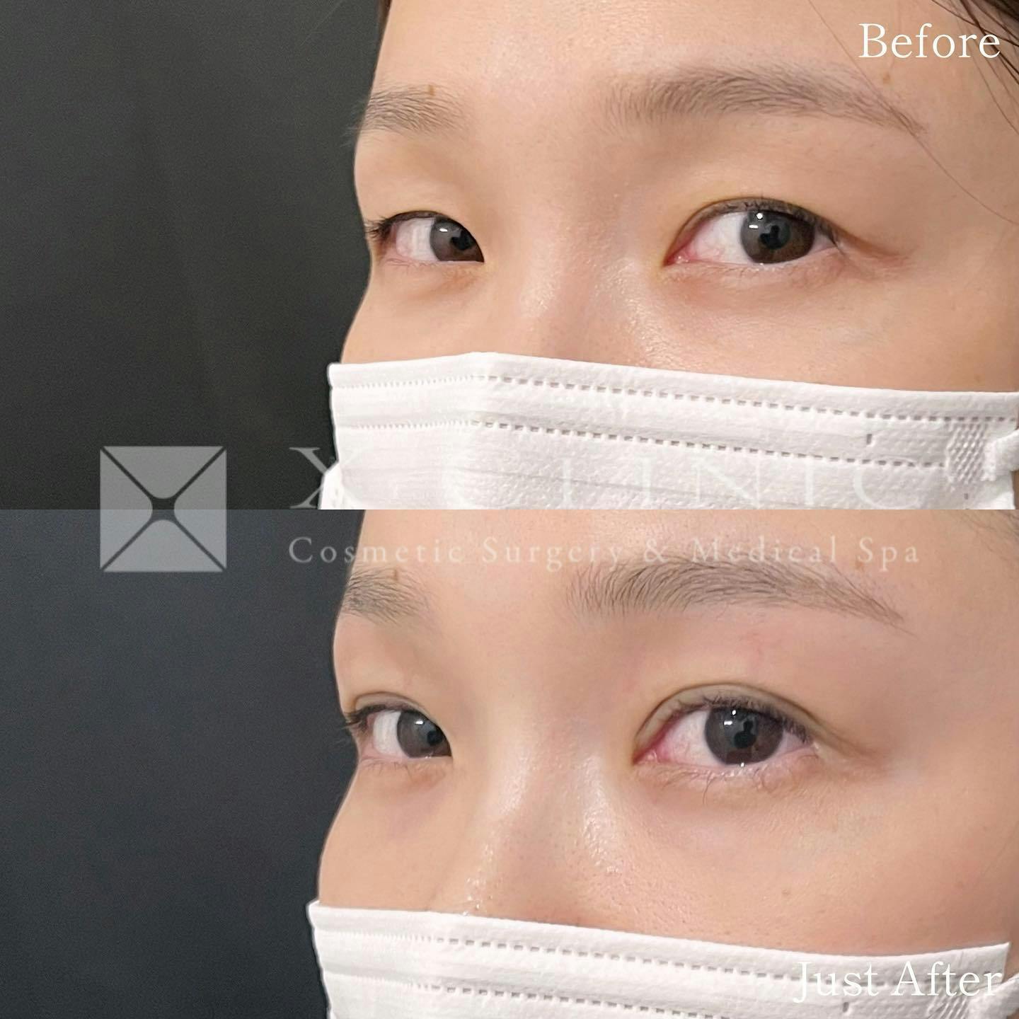 【20代女性・目元】Xクロスダブル_before_aftar