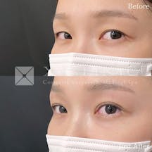 【20代女性・目元】Xクロスダブル_before_aftar