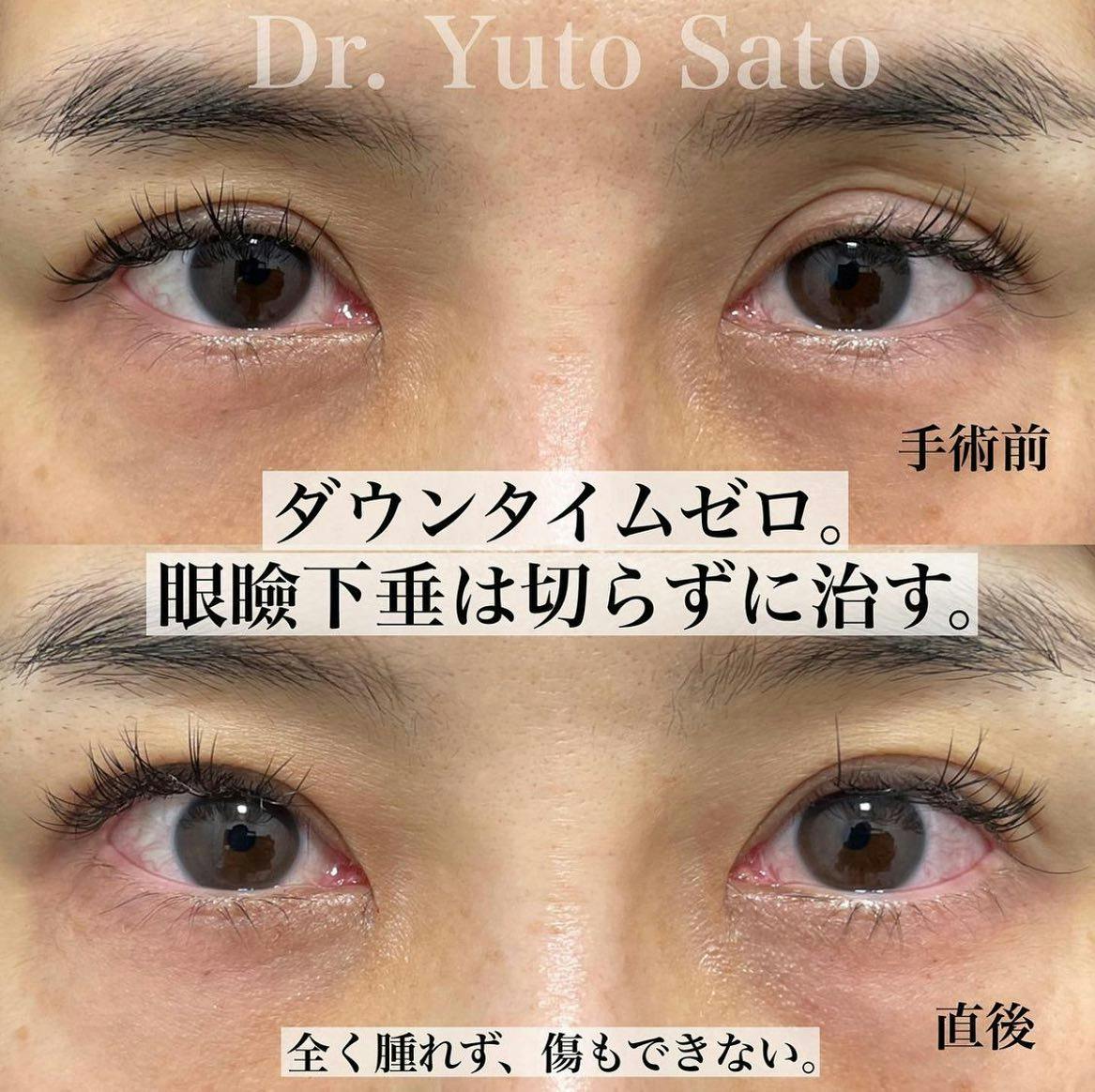 【40代女性・目元】切らない眼瞼下垂プレミアム_before_aftar